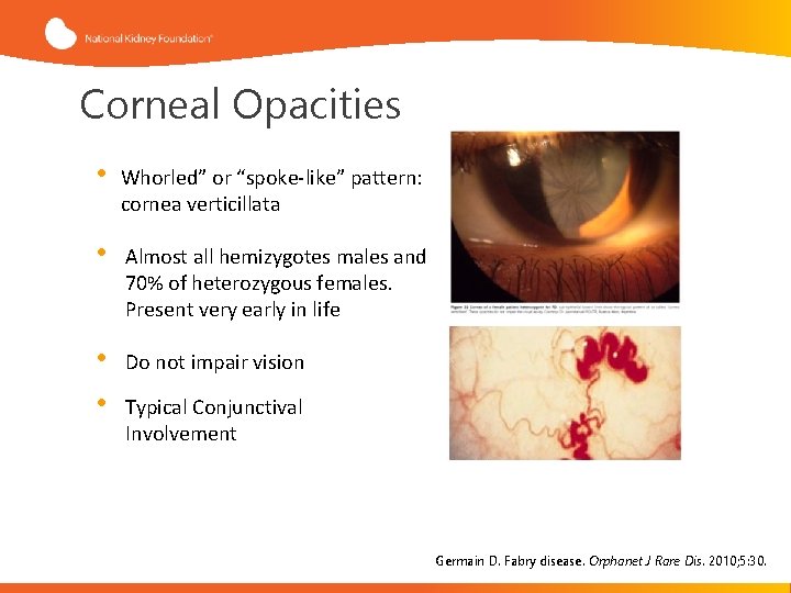 Corneal Opacities • Whorled” or “spoke-like” pattern: cornea verticillata • Almost all hemizygotes males