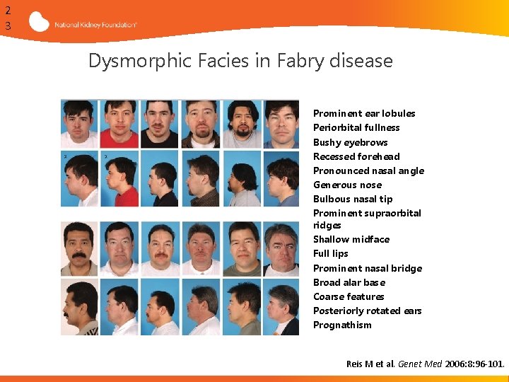 2 3 Dysmorphic Facies in Fabry disease § § § § Prominent ear lobules