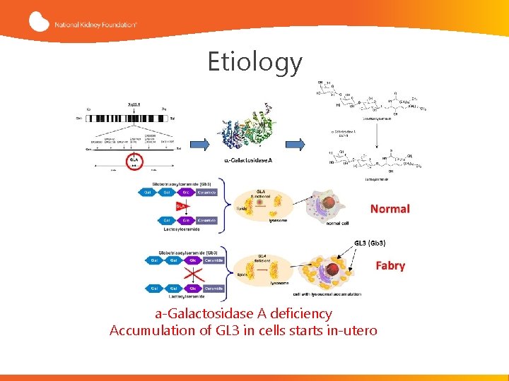 Etiology a-Galactosidase A deficiency Accumulation of GL 3 in cells starts in-utero 