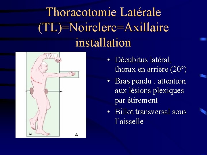 Thoracotomie Latérale (TL)=Noirclerc=Axillaire installation • Décubitus latéral, thorax en arrière (20°) • Bras pendu