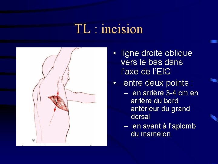 TL : incision • ligne droite oblique vers le bas dans l’axe de l’EIC