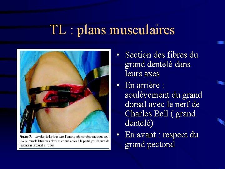 TL : plans musculaires • Section des fibres du grand dentelé dans leurs axes