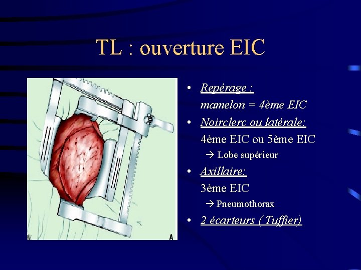 TL : ouverture EIC • Repérage : mamelon = 4ème EIC • Noirclerc ou