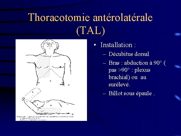 Thoracotomie antérolatérale (TAL) • Installation : – Décubitus dorsal – Bras : abduction à