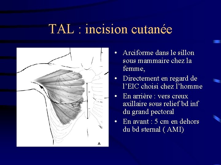 TAL : incision cutanée • Arciforme dans le sillon sous mammaire chez la femme,