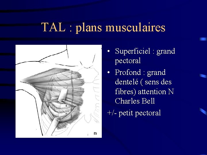 TAL : plans musculaires • Superficiel : grand pectoral • Profond : grand dentelé