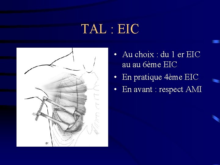 TAL : EIC • Au choix : du 1 er EIC au au 6ème