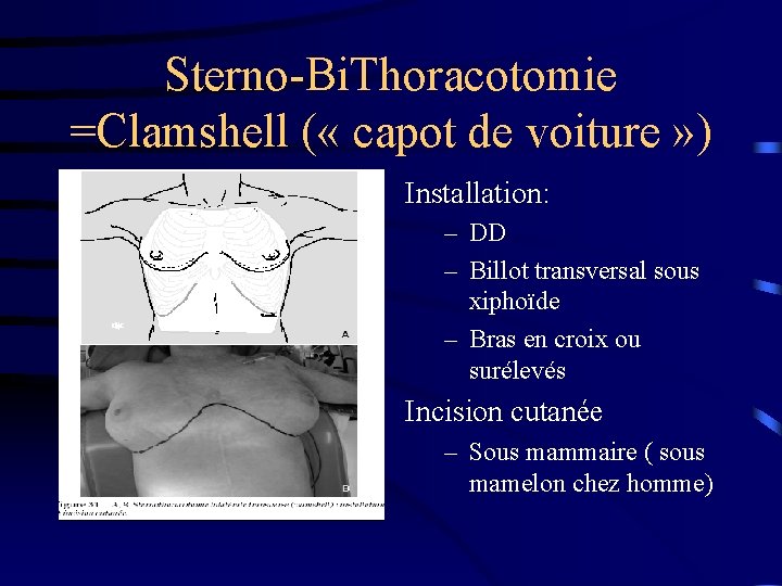 Sterno-Bi. Thoracotomie =Clamshell ( « capot de voiture » ) Installation: – DD –