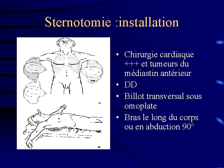 Sternotomie : installation • Chirurgie cardiaque +++ et tumeurs du médiastin antérieur • DD
