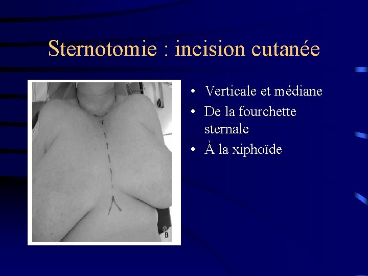Sternotomie : incision cutanée • Verticale et médiane • De la fourchette sternale •