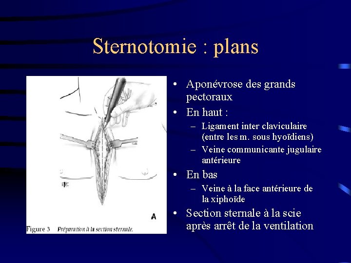 Sternotomie : plans • Aponévrose des grands pectoraux • En haut : – Ligament