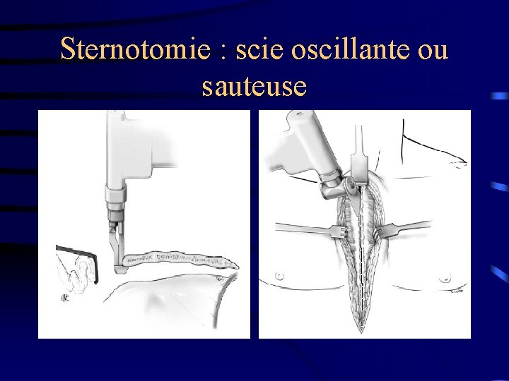 Sternotomie : scie oscillante ou sauteuse 