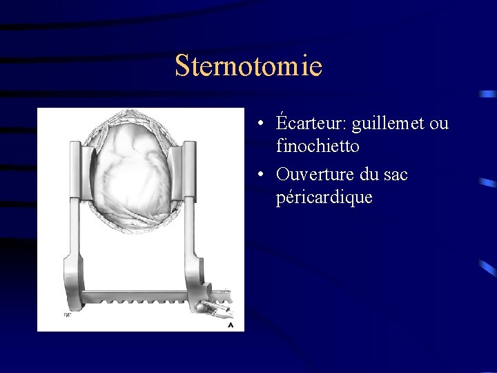 Sternotomie • Écarteur: guillemet ou finochietto • Ouverture du sac péricardique 