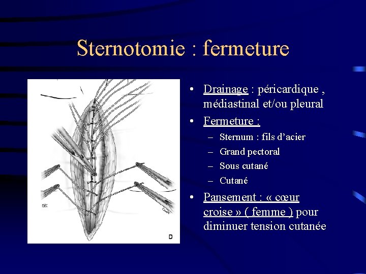 Sternotomie : fermeture • Drainage : péricardique , médiastinal et/ou pleural • Fermeture :