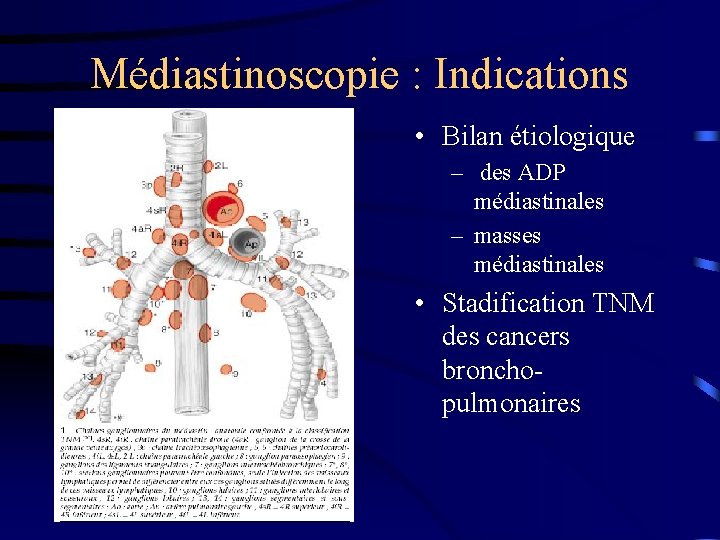 Médiastinoscopie : Indications • Bilan étiologique – des ADP médiastinales – masses médiastinales •