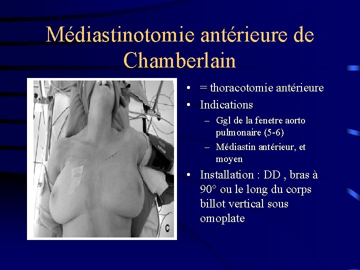 Médiastinotomie antérieure de Chamberlain • = thoracotomie antérieure • Indications – Ggl de la