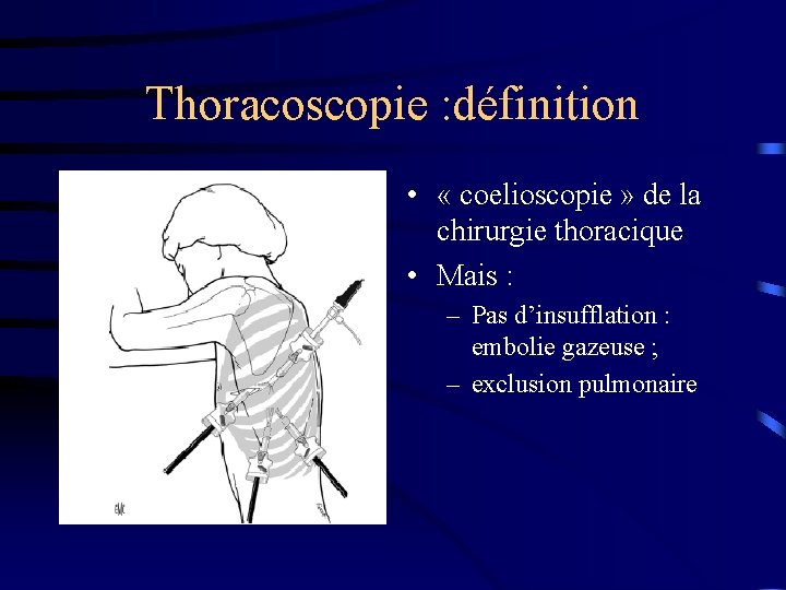 Thoracoscopie : définition • « coelioscopie » de la chirurgie thoracique • Mais :