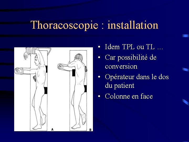 Thoracoscopie : installation • Idem TPL ou TL … • Car possibilité de conversion