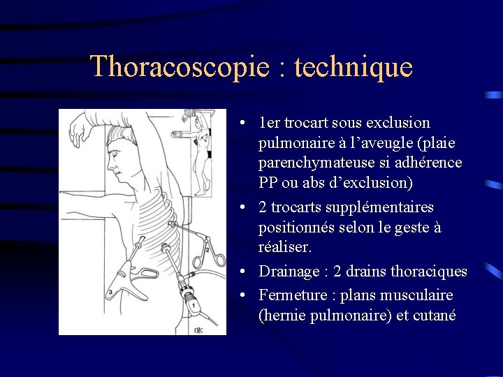 Thoracoscopie : technique • 1 er trocart sous exclusion pulmonaire à l’aveugle (plaie parenchymateuse