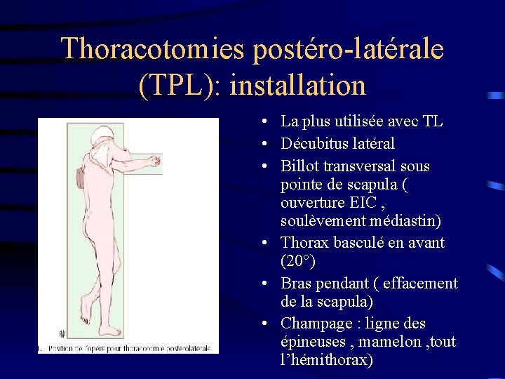 Thoracotomies postéro-latérale (TPL): installation • La plus utilisée avec TL • Décubitus latéral •