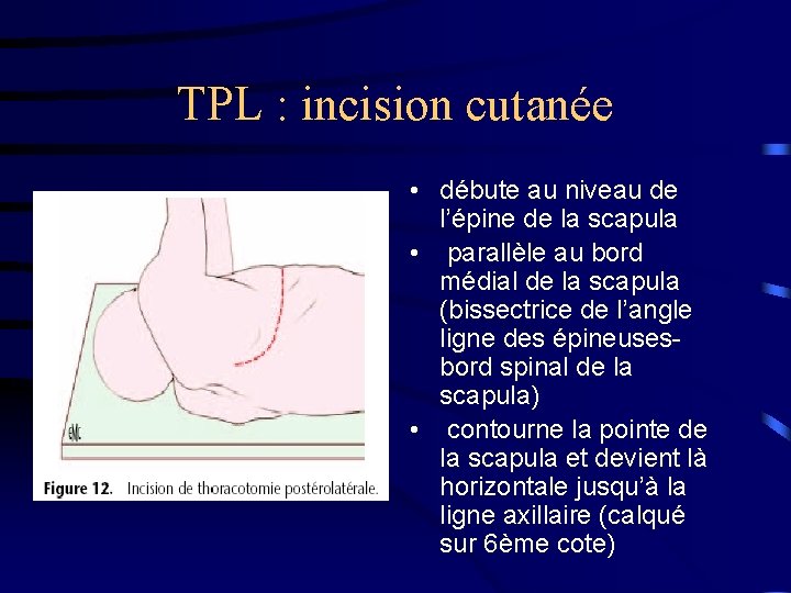 TPL : incision cutanée • débute au niveau de l’épine de la scapula •