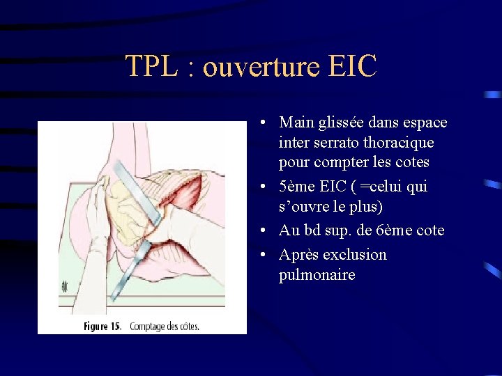 TPL : ouverture EIC • Main glissée dans espace inter serrato thoracique pour compter