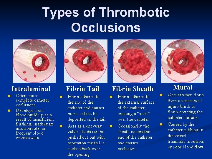 Types of Thrombotic Occlusions Intraluminal n n Often cause complete catheter occlusions Develops from