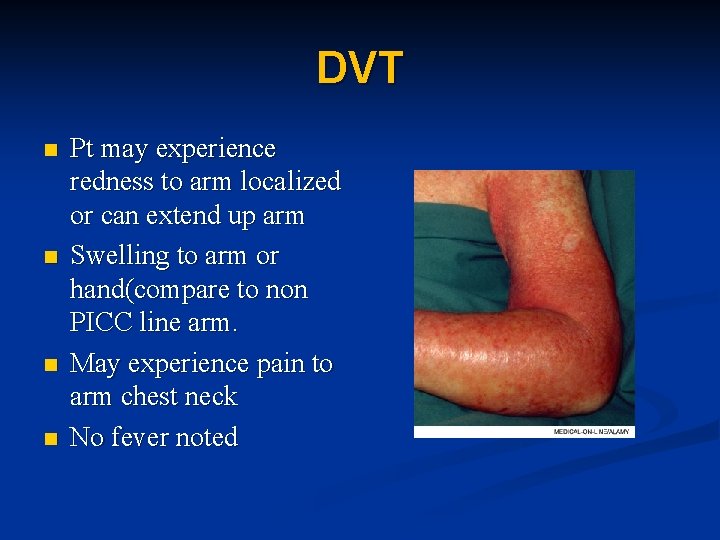 DVT n n Pt may experience redness to arm localized or can extend up