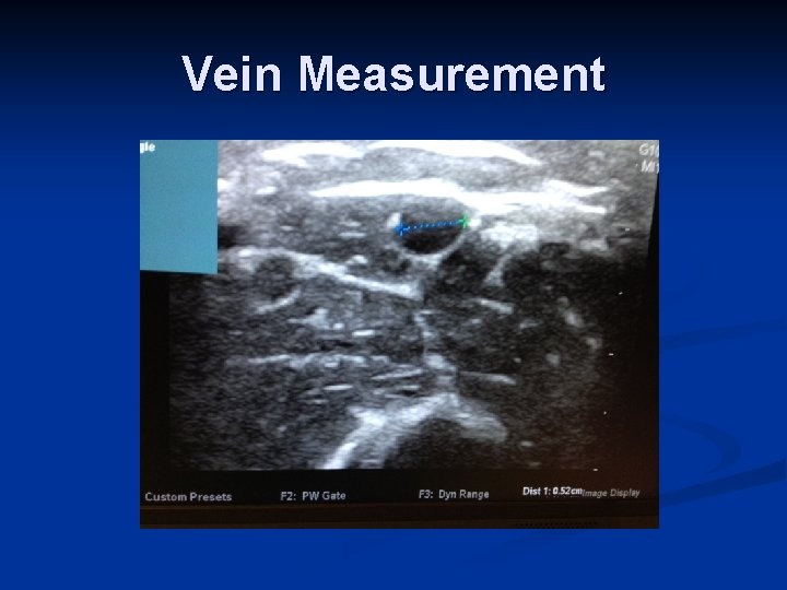 Vein Measurement Vein Measurement
