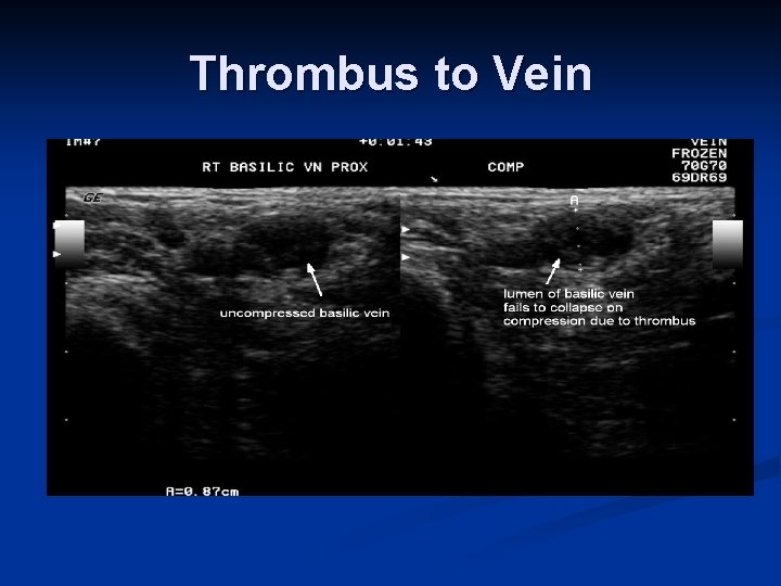 Thrombus to Vein Thrombus to Vein