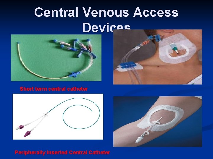 Central Venous Access Devices Short term central catheter Peripherally Inserted Central Catheter 