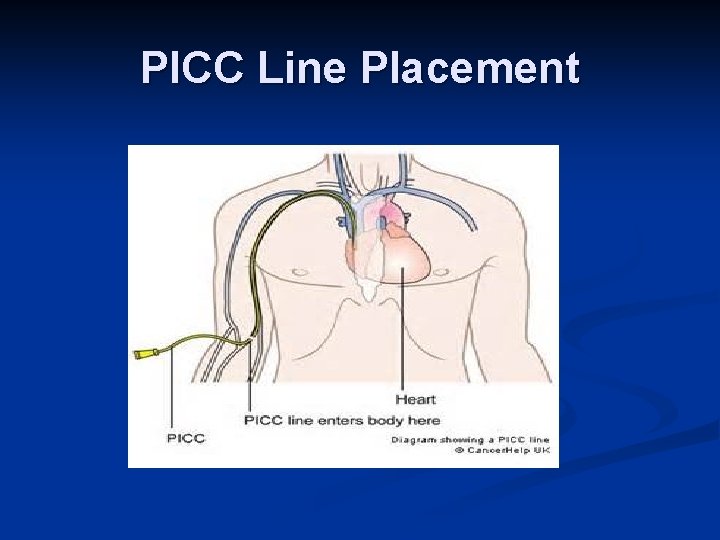 PICC Line Placement 