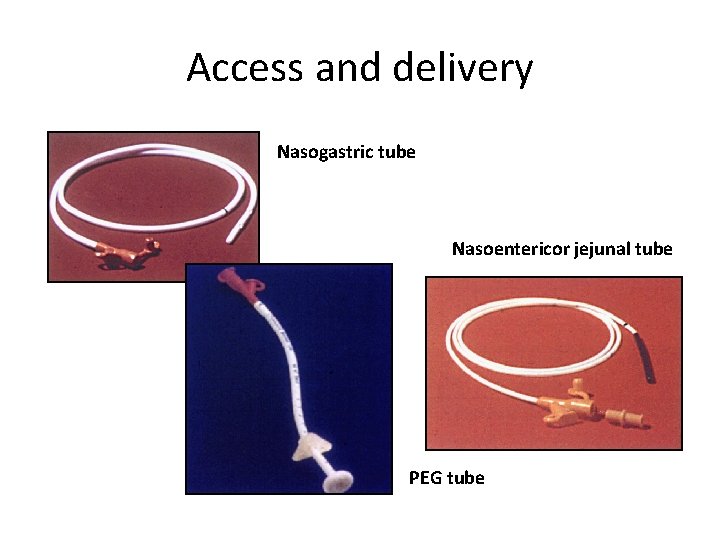 Access and delivery Nasogastric tube Nasoentericor jejunal tube PEG tube 