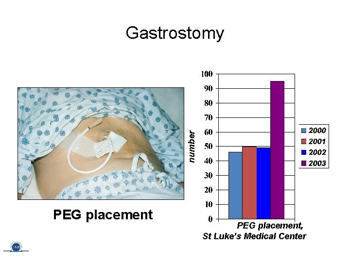 Gastrostomy PEG placement, St Luke’s Medical Center 