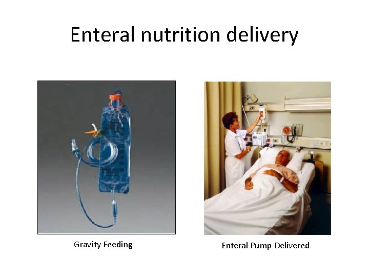 Enteral nutrition delivery Gravity Feeding Enteral Pump Delivered 