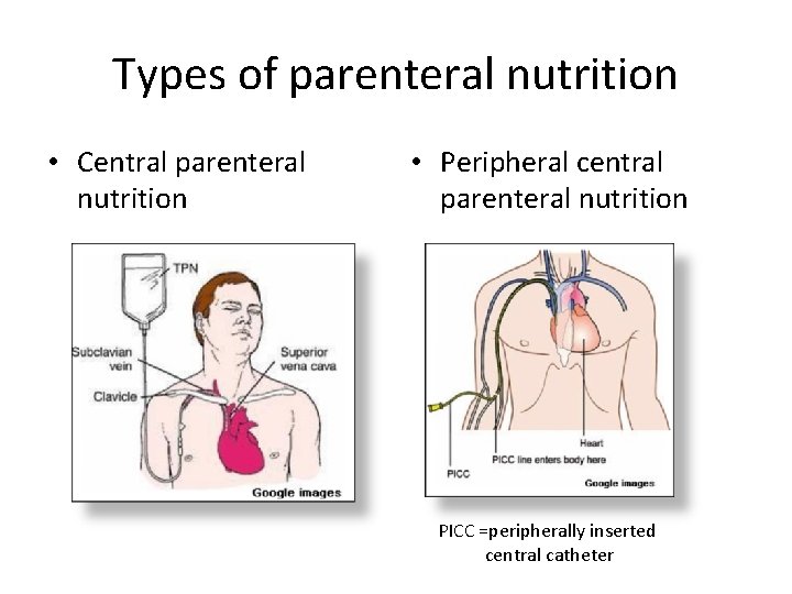 Types of parenteral nutrition • Central parenteral nutrition • Peripheral central parenteral nutrition PICC