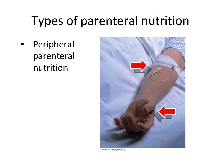 Types of parenteral nutrition • Peripheral parenteral nutrition 