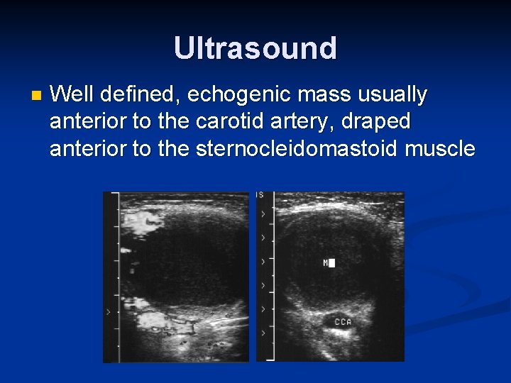 Ultrasound n Well defined, echogenic mass usually anterior to the carotid artery, draped anterior