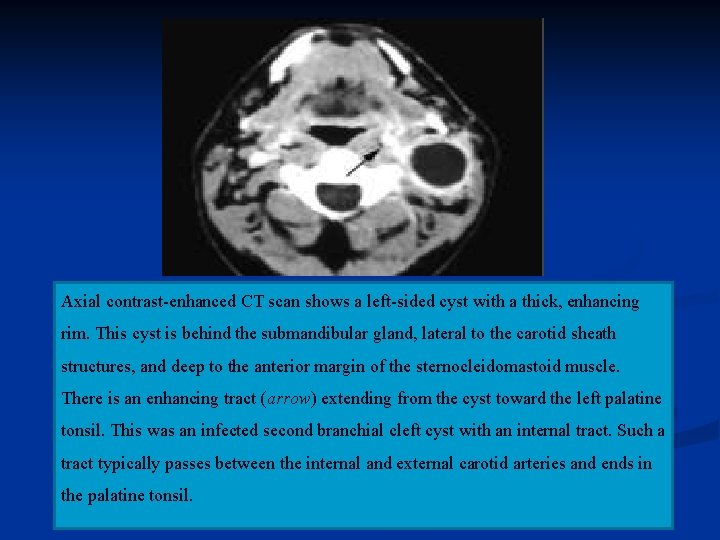 Axial contrast-enhanced CT scan shows a left-sided cyst with a thick, enhancing rim. This