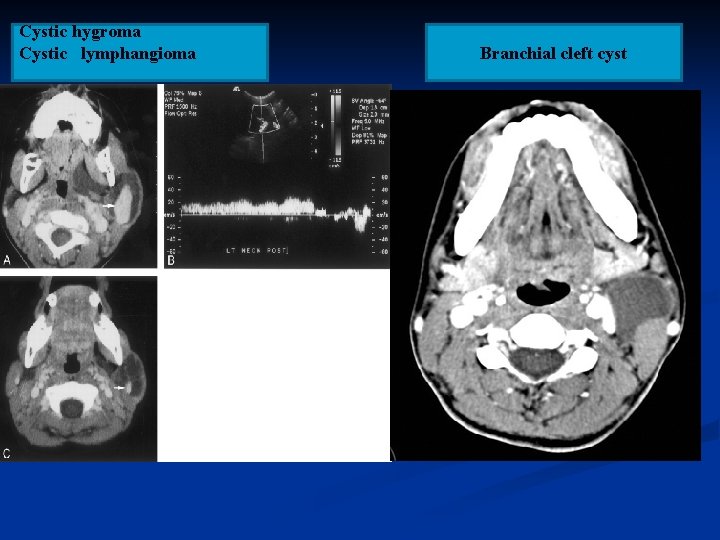 Cystic hygroma Cystic lymphangioma Branchial cleft cyst 