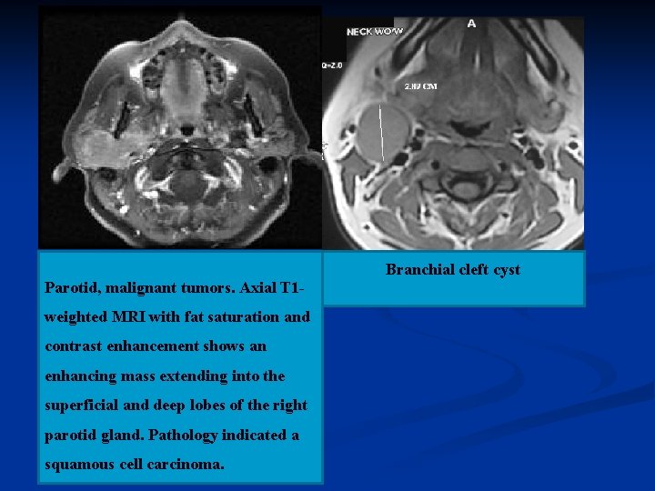 Parotid, malignant tumors. Axial T 1 weighted MRI with fat saturation and contrast enhancement