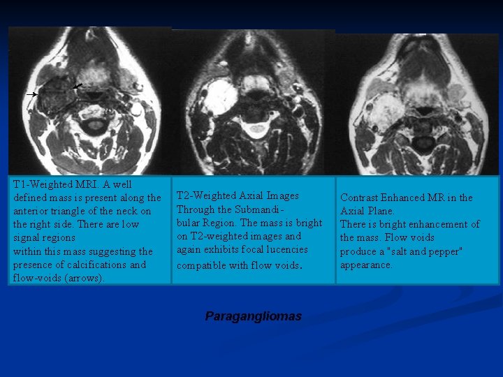 T 1 -Weighted MRI. A well defined mass is present along the anterior triangle