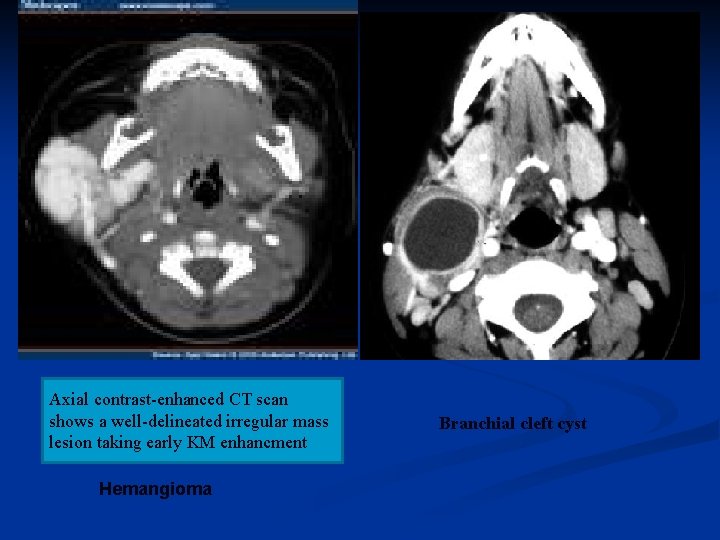 Axial contrast-enhanced CT scan shows a well-delineated irregular mass lesion taking early KM enhancment