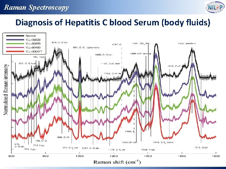 Raman Spectroscopy Diagnosis of Hepatitis C blood Serum (body fluids) 