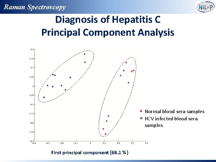 Raman Spectroscopy Diagnosis of Hepatitis C Principal Component Analysis Normal blood sera samples HCV