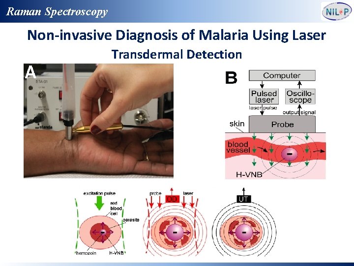 Raman Spectroscopy Non-invasive Diagnosis of Malaria Using Laser Transdermal Detection 