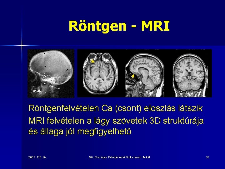 Röntgen - MRI Röntgenfelvételen Ca (csont) eloszlás látszik MRI felvételen a lágy szövetek 3