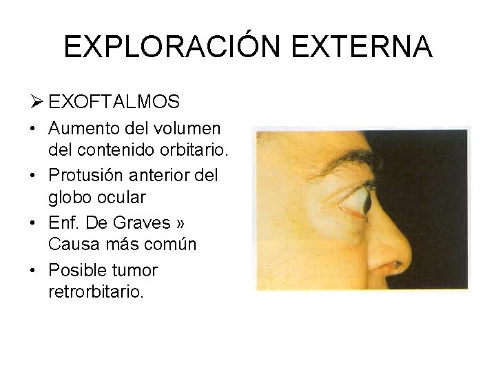 EXPLORACIÓN EXTERNA Ø EXOFTALMOS • Aumento del volumen del contenido orbitario. • Protusión anterior