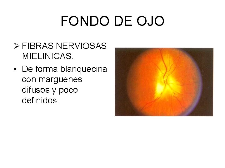 FONDO DE OJO Ø FIBRAS NERVIOSAS MIELINICAS. • De forma blanquecina con marguenes difusos