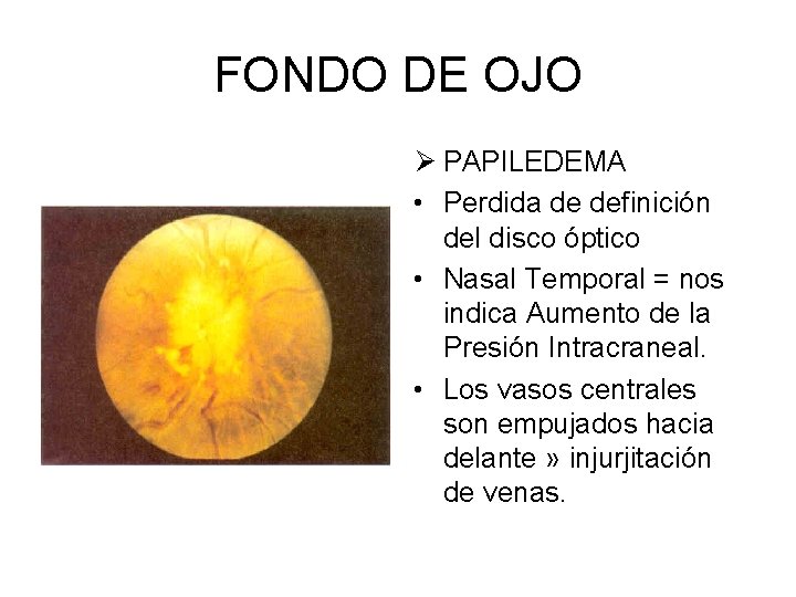 FONDO DE OJO Ø PAPILEDEMA • Perdida de definición del disco óptico • Nasal